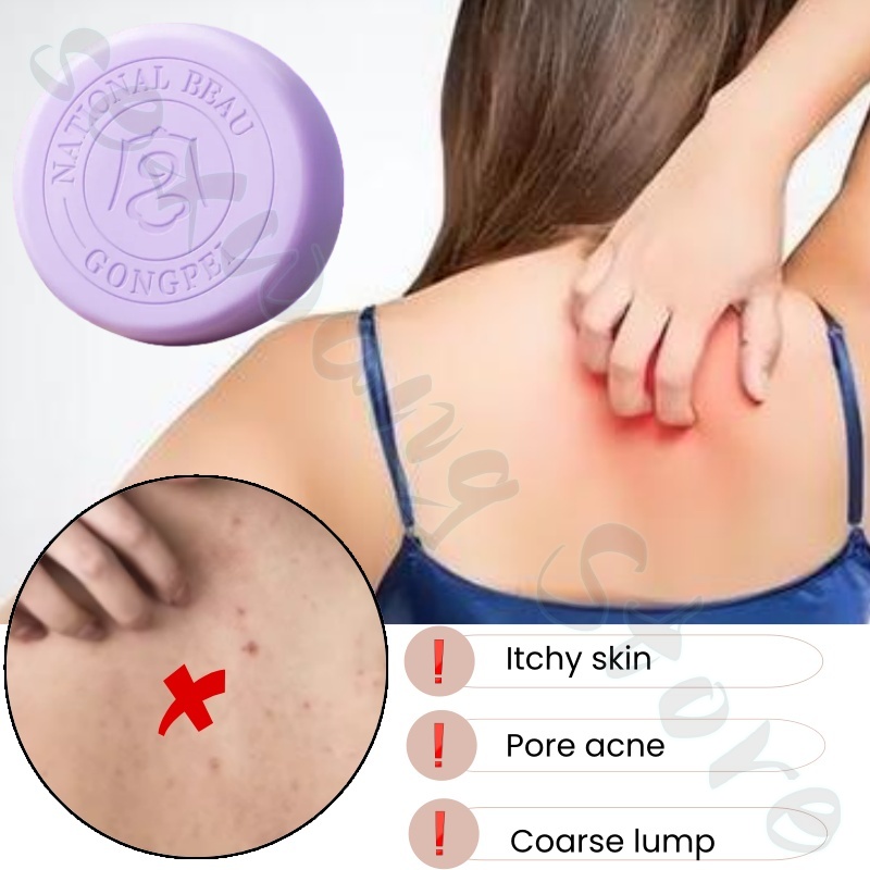 Salicylic acid perilla demodex - Salicylic Acid Blackhead Remover ulasan dan harga